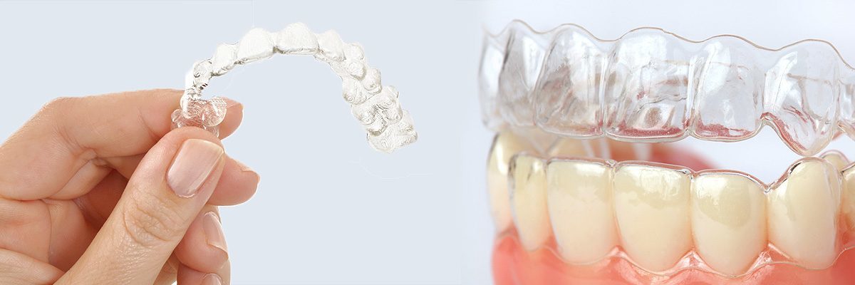 Mission Viejo Alternative to Braces for Teens