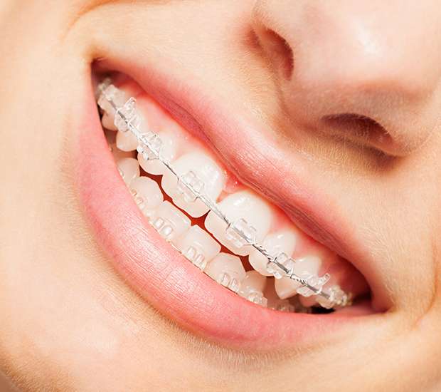 Mission Viejo Invisible Orthodontics