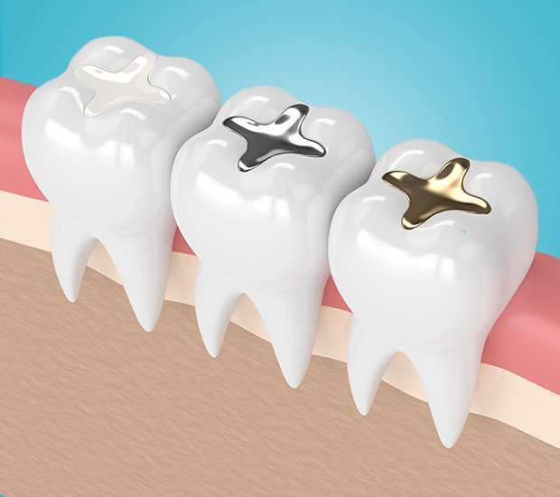 Mission Viejo Composite Fillings