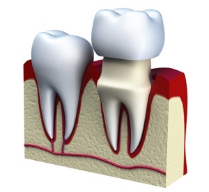 Mission Viejo, Ca patients get new tooth in one day, thanks to CEREC digital crown system