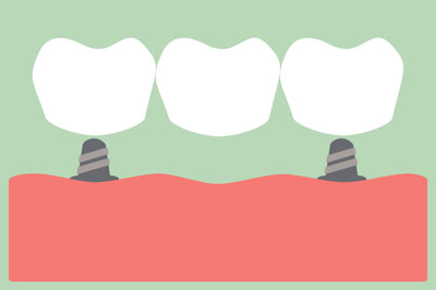 Dental Bridge