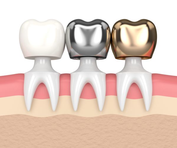 Advantages Of Same Day CEREC Crowns