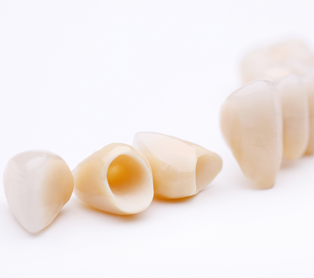 Mission Viejo Dental Crowns and Dental Bridges