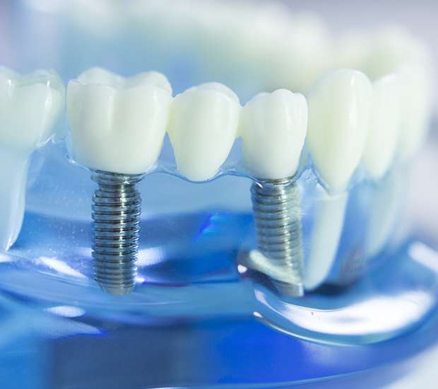 Mission Viejo Dental Implants