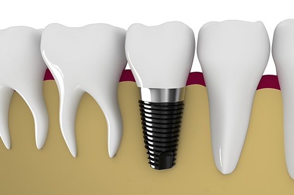 Dental Implants