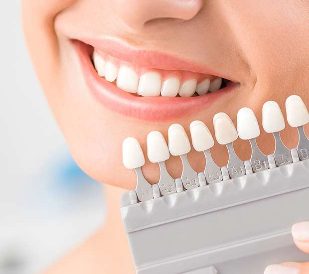 Mission Viejo Veneers