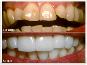 Dental Veneers