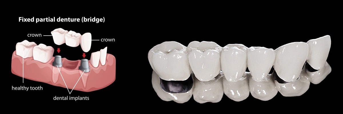 Mission Viejo Dentures