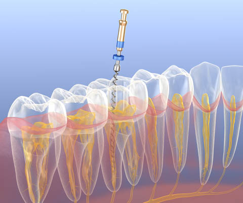 Root Canal Mission Viejo, CA