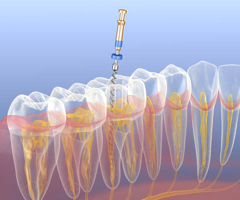 Root Canal Therapy For A Tooth Infection