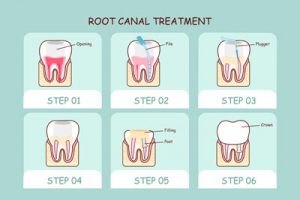 You May Need A General Dentist If Your Tooth Starts Hurting After A Root Canal