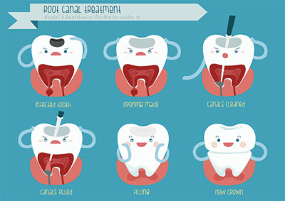 Visit A Root Canal Dentist To Have An Infection Removed