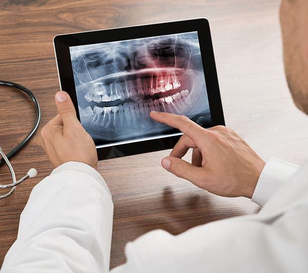 Mission Viejo Types of Dental Root Fractures
